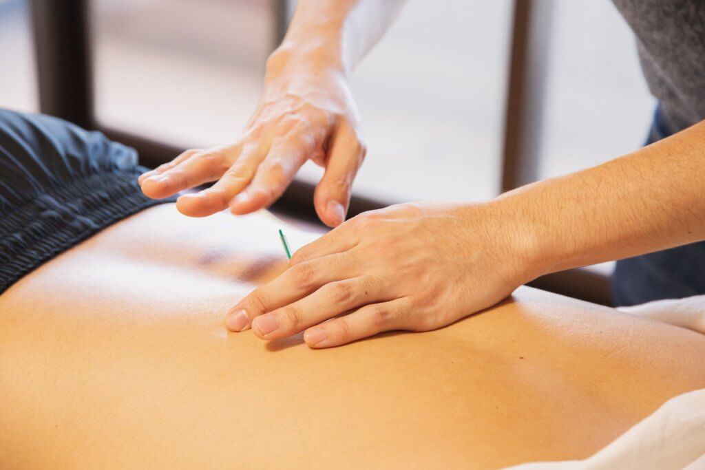 acupuncture on back