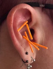 auriculotherapy ear acupuncture needles